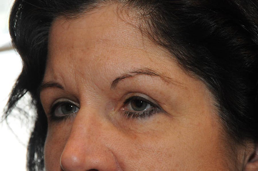 Upper Blepharoplasty Before & After Gallery - Patient 404741 - Image 2