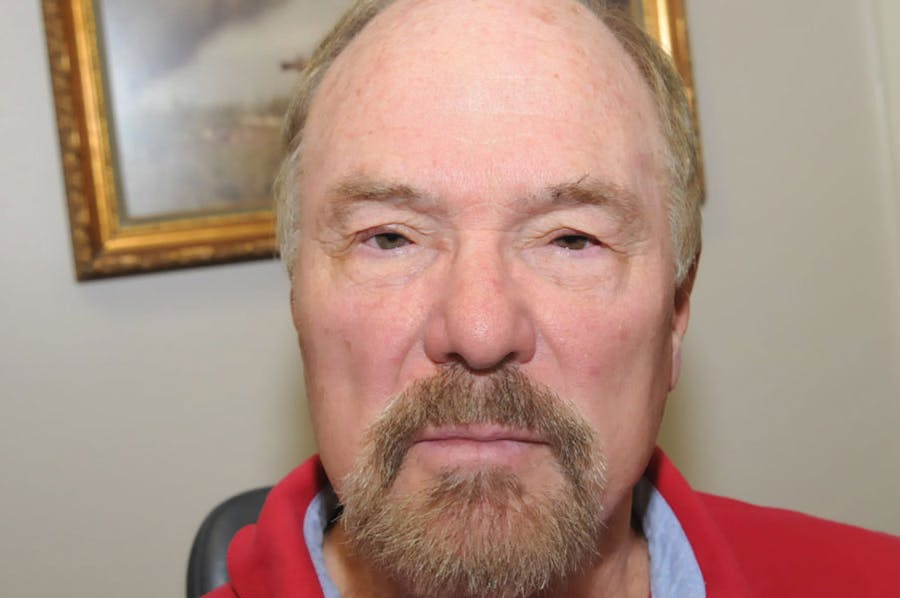 Upper Blepharoplasty Before & After Gallery - Patient 279789 - Image 1