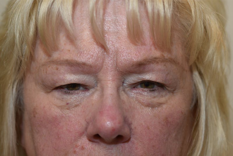 Lower Blepharoplasty Before & After Gallery - Patient 117120 - Image 1