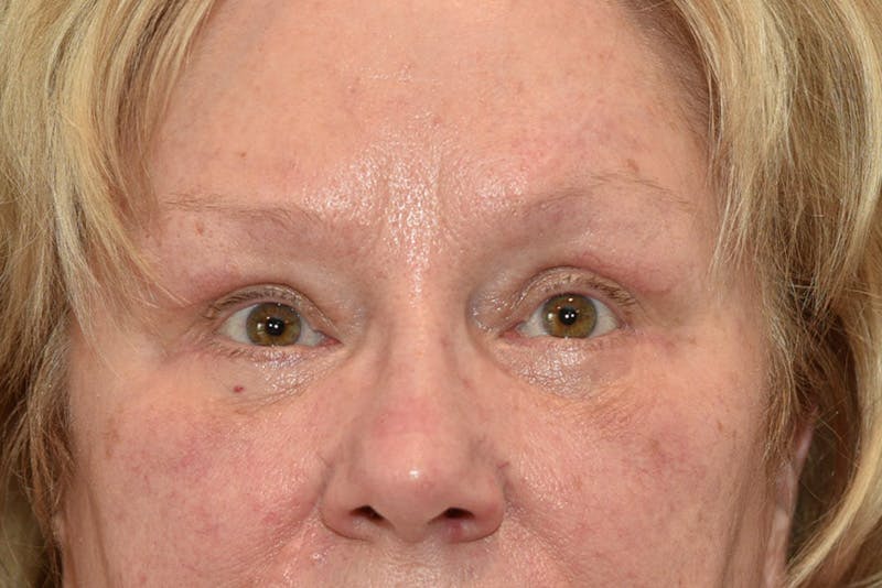 Lower Blepharoplasty Before & After Gallery - Patient 117120 - Image 2