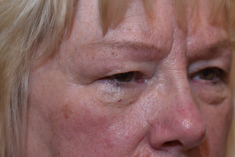 Lower Blepharoplasty Before & After Gallery - Patient 117120 - Image 3