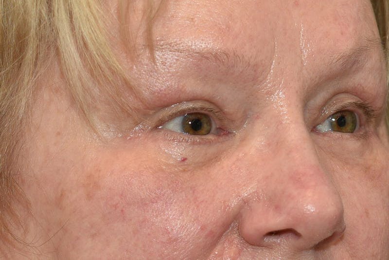Lower Blepharoplasty Before & After Gallery - Patient 117120 - Image 4