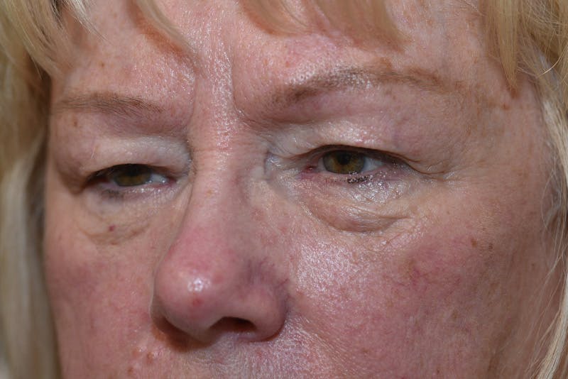 Lower Blepharoplasty Before & After Gallery - Patient 117120 - Image 5