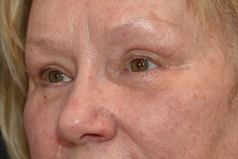 Lower Blepharoplasty Before & After Gallery - Patient 117120 - Image 6