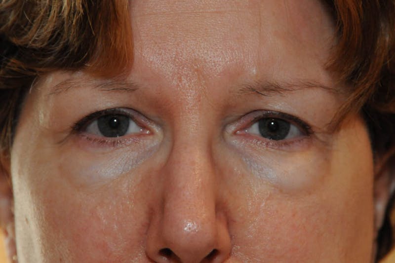 Lower Blepharoplasty Before & After Gallery - Patient 278271 - Image 1