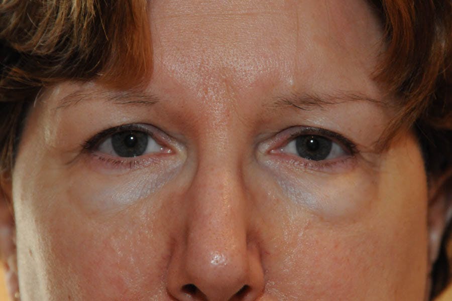 Lower Blepharoplasty Before & After Gallery - Patient 278271 - Image 1