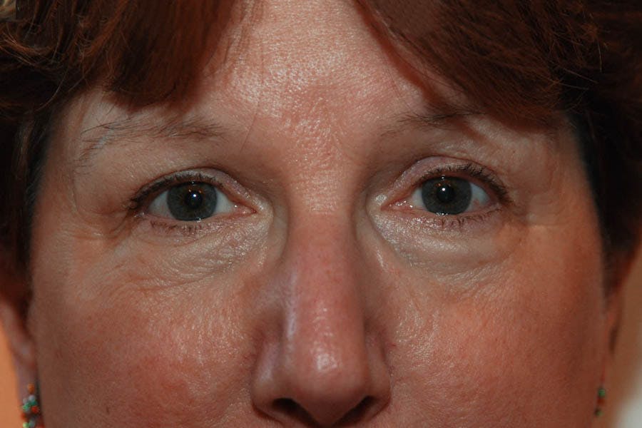 Lower Blepharoplasty Before & After Gallery - Patient 278271 - Image 2