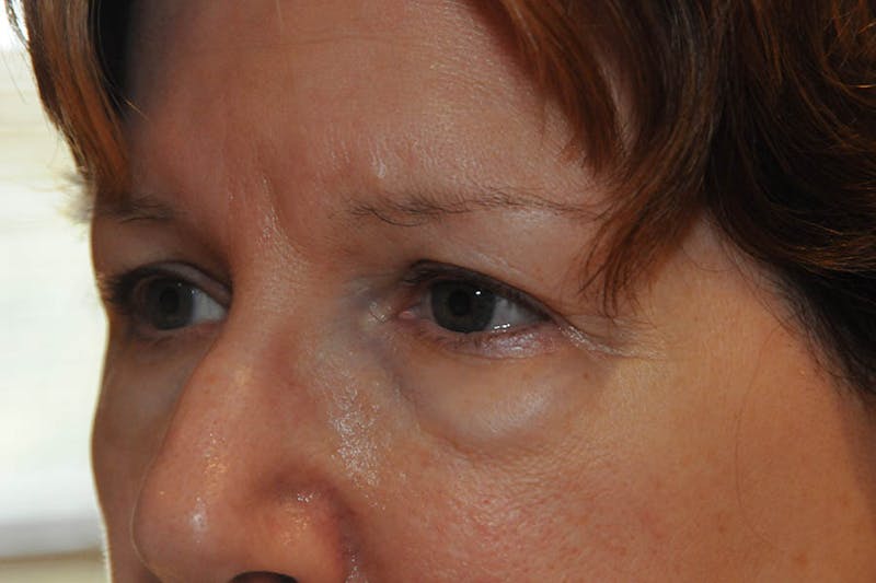 Lower Blepharoplasty Before & After Gallery - Patient 278271 - Image 3
