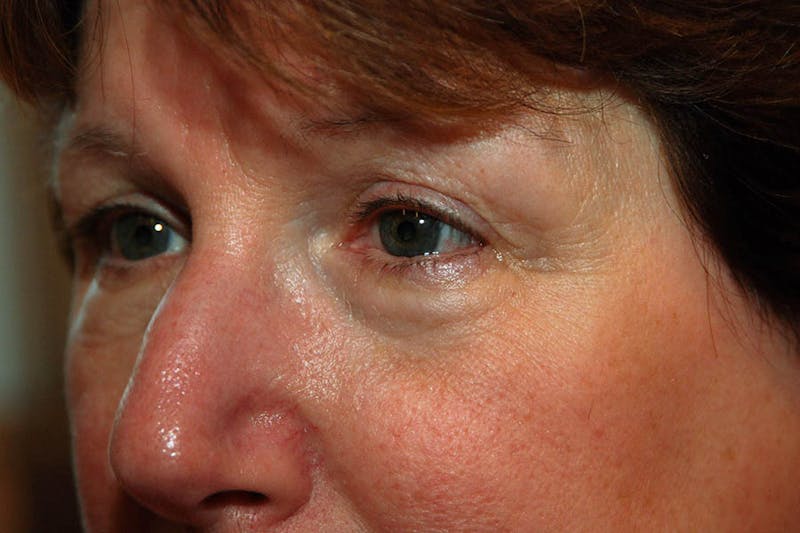 Lower Blepharoplasty Before & After Gallery - Patient 278271 - Image 4