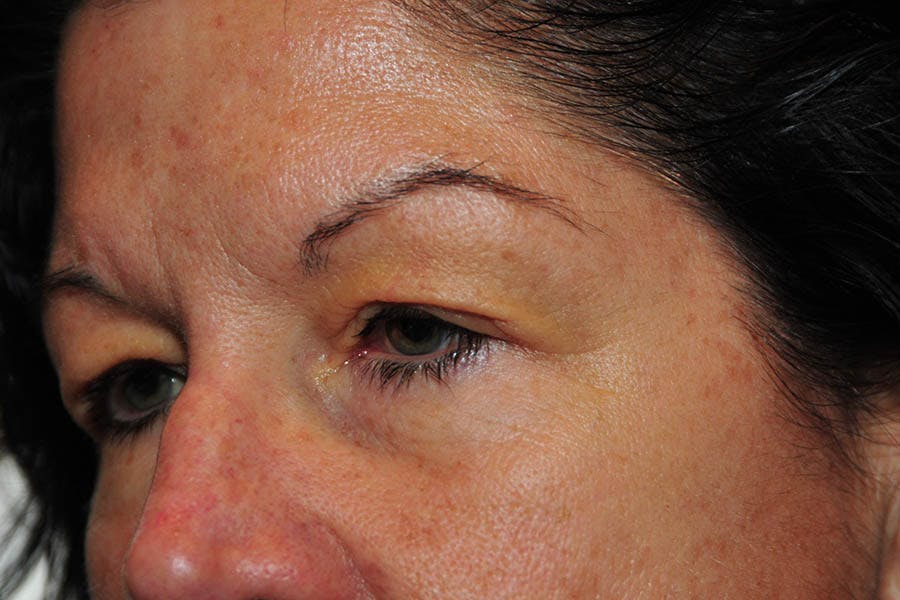 Lower Blepharoplasty Before & After Gallery - Patient 684593 - Image 1
