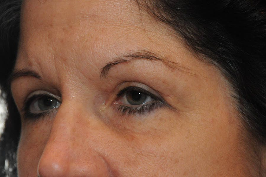 Lower Blepharoplasty Before & After Gallery - Patient 684593 - Image 2