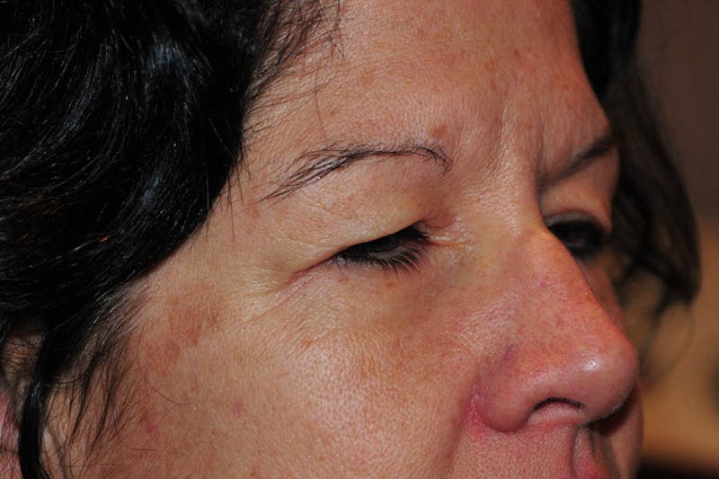 Lower Blepharoplasty Before & After Gallery - Patient 684593 - Image 3