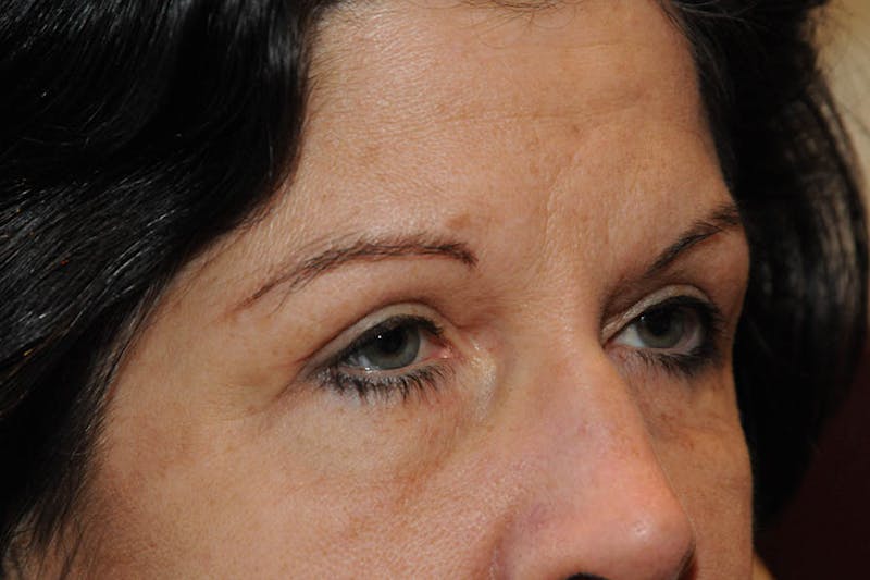 Lower Blepharoplasty Before & After Gallery - Patient 684593 - Image 4