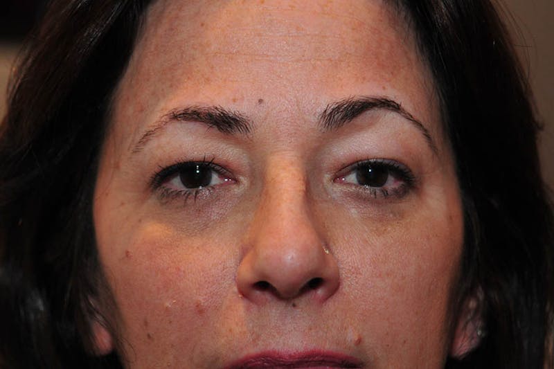 Lower Blepharoplasty Before & After Gallery - Patient 217094 - Image 1