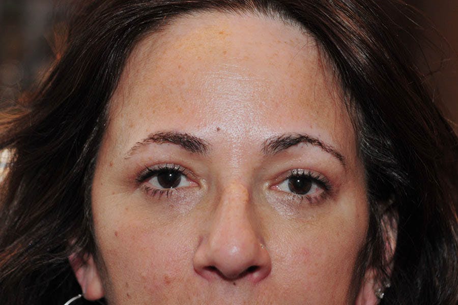 Lower Blepharoplasty Before & After Gallery - Patient 217094 - Image 2