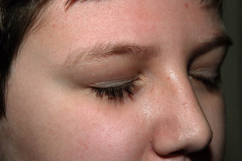 Facial Surgery Options Before & After Gallery - Patient 344049 - Image 2
