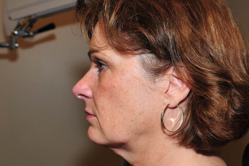 Facelift Before & After Gallery - Patient 130681 - Image 1