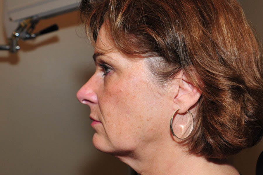 Facelift Before & After Gallery - Patient 130681 - Image 1