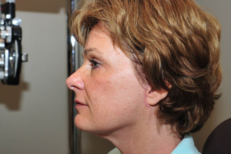 Facelift Before & After Gallery - Patient 130681 - Image 2