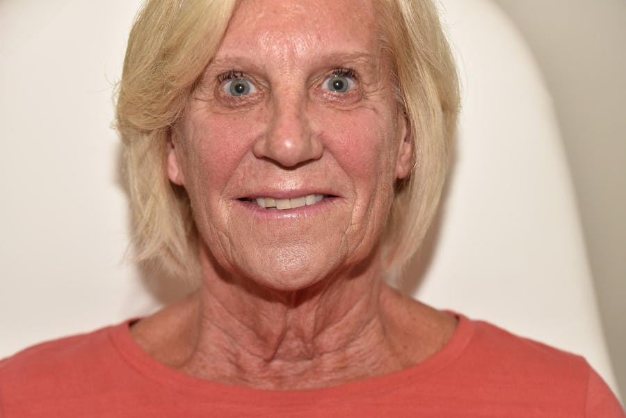 Facelift Before & After Gallery - Patient 990377 - Image 1