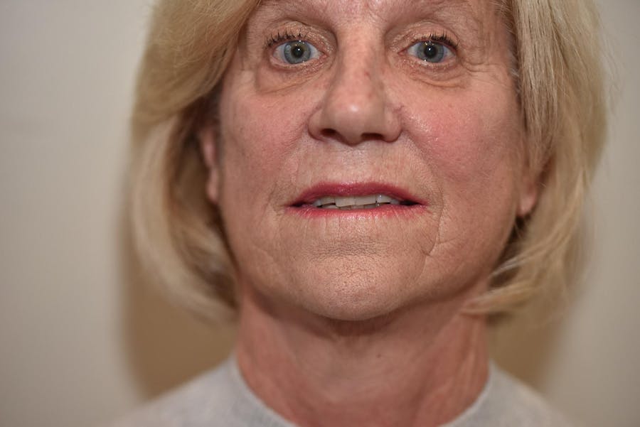 Facelift Before & After Gallery - Patient 990377 - Image 2