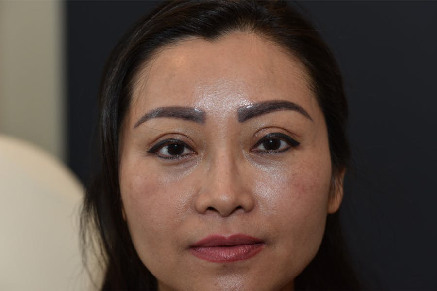 Endoscopic Brow Lift Before & After Gallery - Patient 115511 - Image 2