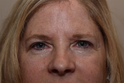 Endoscopic Brow Lift with Upper Blepharoplasty Before & After Gallery - Patient 575482 - Image 1