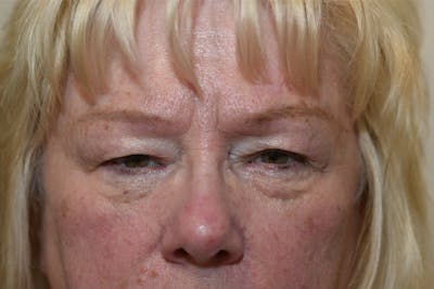 Endoscopic Brow Lift with Upper Blepharoplasty Before & After Gallery - Patient 769749 - Image 1