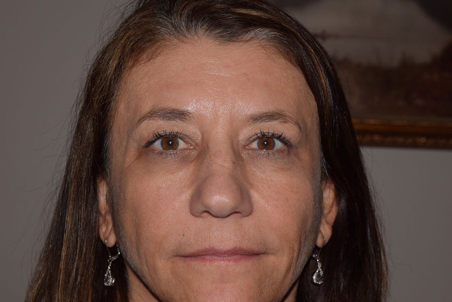 Cosmetic Facial Surgery Options Before & After Gallery - Patient 238172 - Image 1