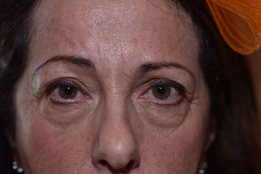 Cosmetic Facial Surgery Options Before & After Gallery - Patient 104254 - Image 1