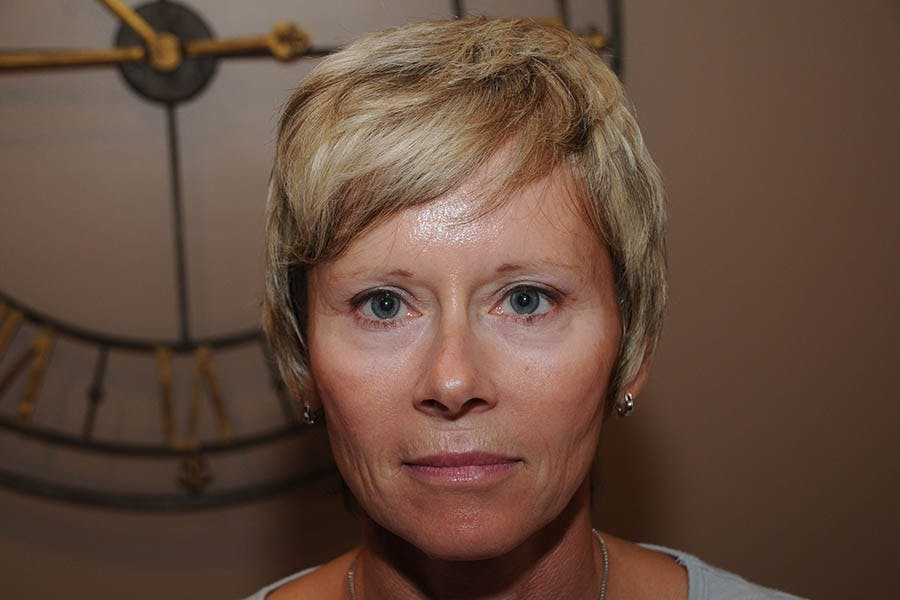 Endoscopic Brow Lift Before & After Gallery - Patient 253750 - Image 2