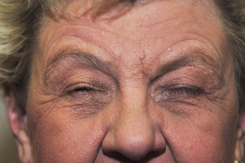 Brow Lift Before & After Gallery - Patient 263829 - Image 3