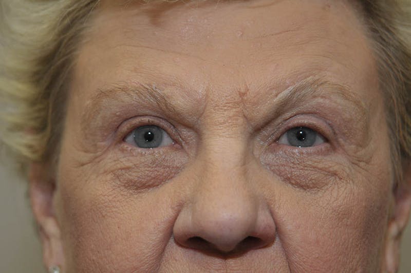 Brow Lift Before & After Gallery - Patient 263829 - Image 4