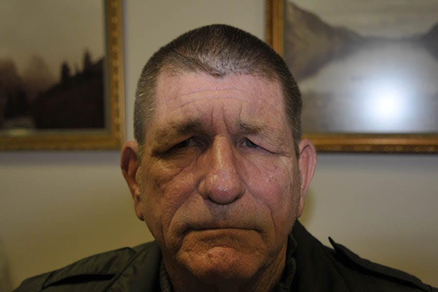 Brow Lift Before & After Gallery - Patient 850552 - Image 1