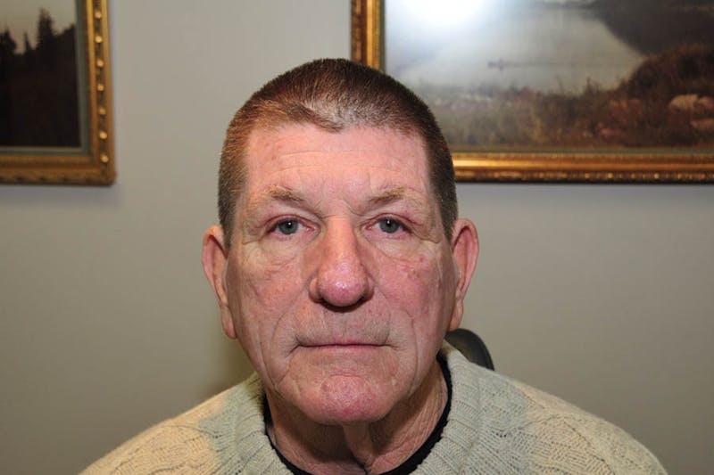 Brow Lift Before & After Gallery - Patient 850552 - Image 2