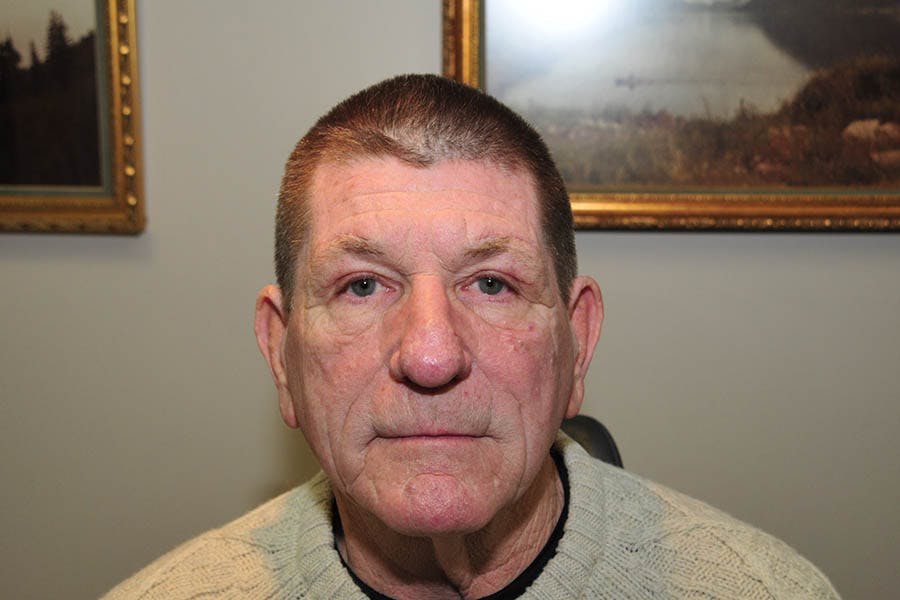Brow Lift Before & After Gallery - Patient 850552 - Image 2