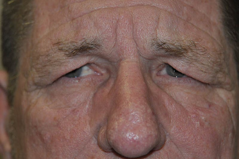 Brow Lift Before & After Gallery - Patient 850552 - Image 3