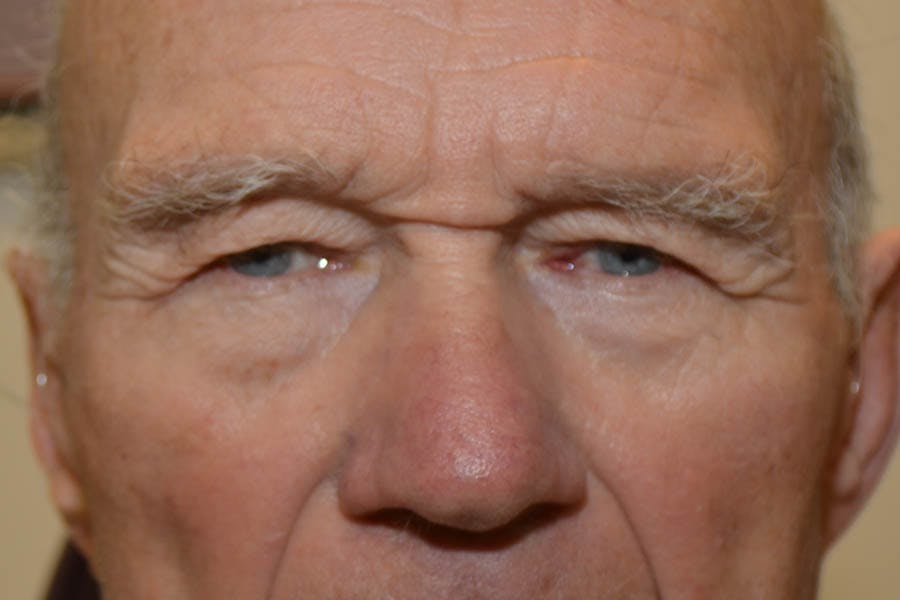 Brow Lift Before & After Gallery - Patient 410798 - Image 1