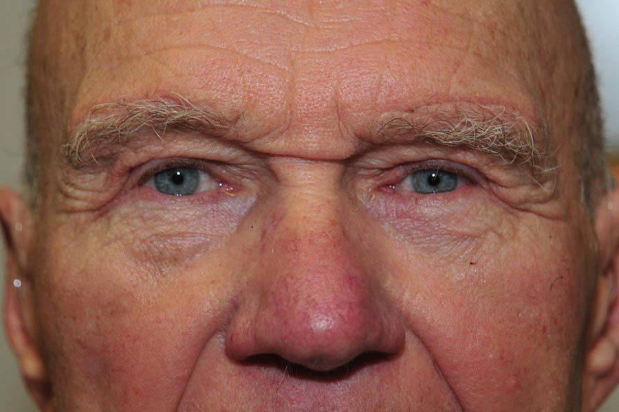 Brow Lift Before & After Gallery - Patient 410798 - Image 2