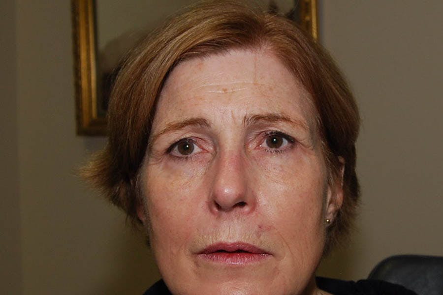 Fillers Before & After Gallery - Patient 388354 - Image 1