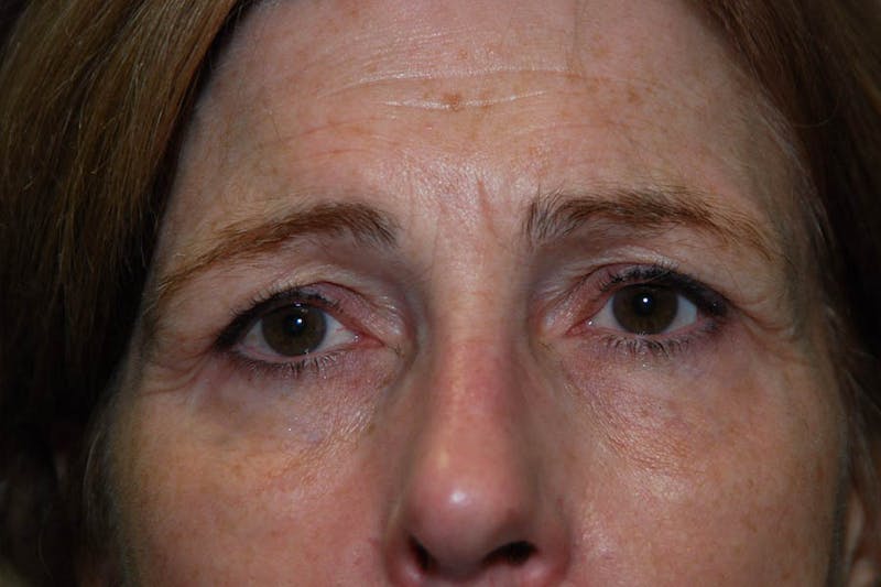 Fillers Before & After Gallery - Patient 388354 - Image 3