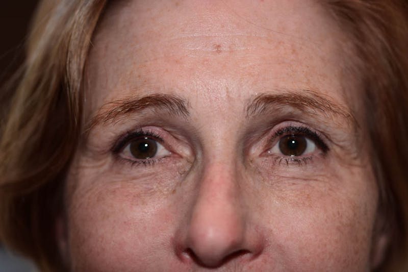 Fillers Before & After Gallery - Patient 388354 - Image 4