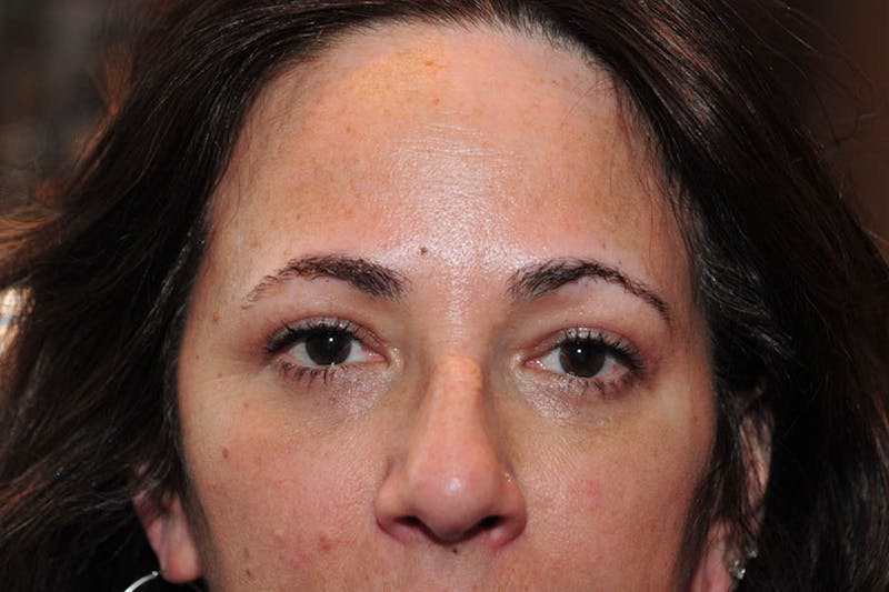 CO2 Laser Resurfacing Before & After Gallery - Patient 385700 - Image 2