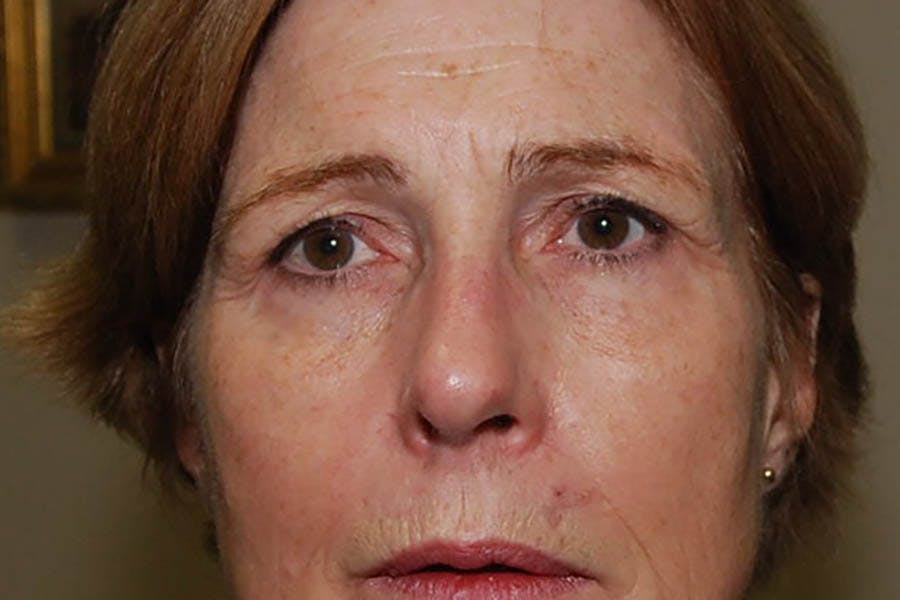BOTOX Before & After Gallery - Patient 269651 - Image 1