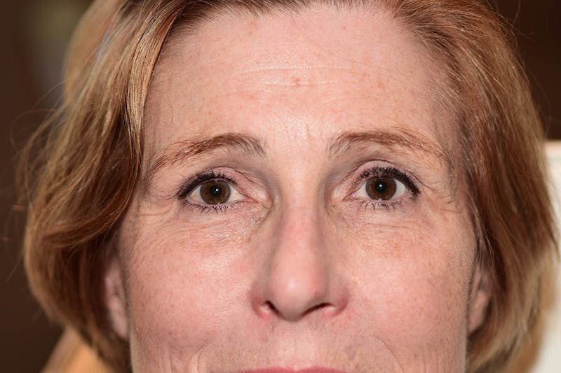 BOTOX Before & After Gallery - Patient 269651 - Image 2