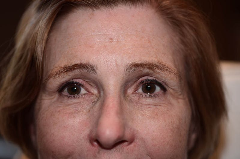 BOTOX Before & After Gallery - Patient 269651 - Image 4