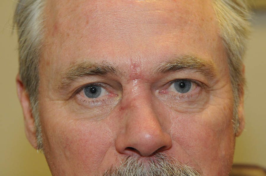 Skin Cancer Before & After Gallery - Patient 190103 - Image 2