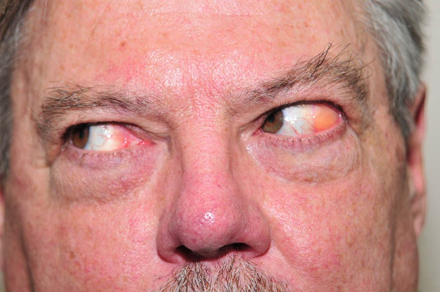 Reconstructive Eye Before & After Gallery - Patient 639369 - Image 1