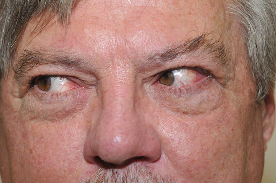Reconstructive Eye Before & After Gallery - Patient 639369 - Image 2