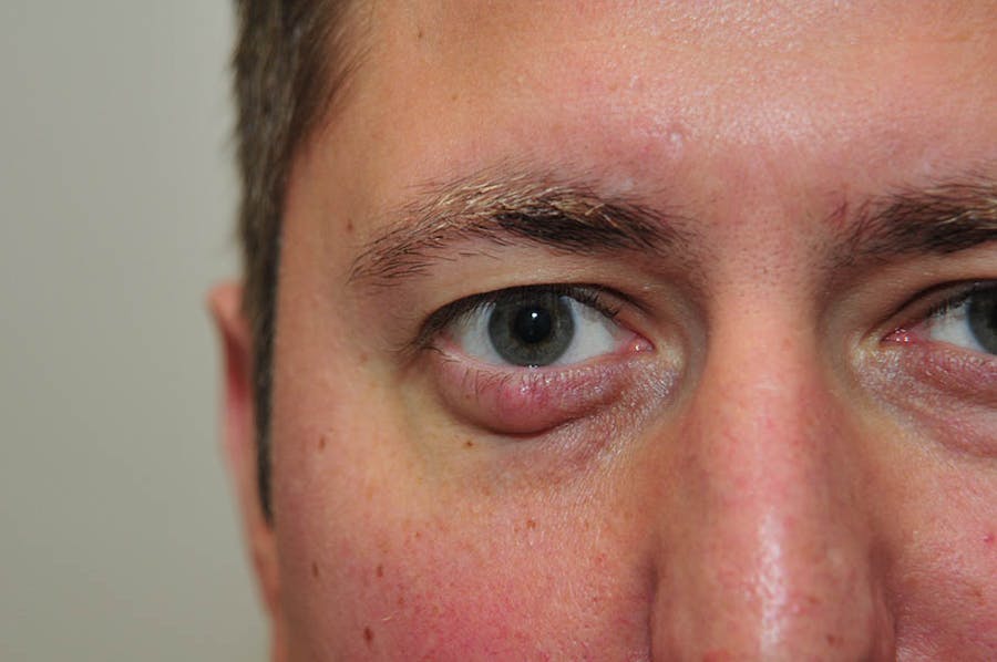 Reconstructive Eye Before & After Gallery - Patient 175252 - Image 1